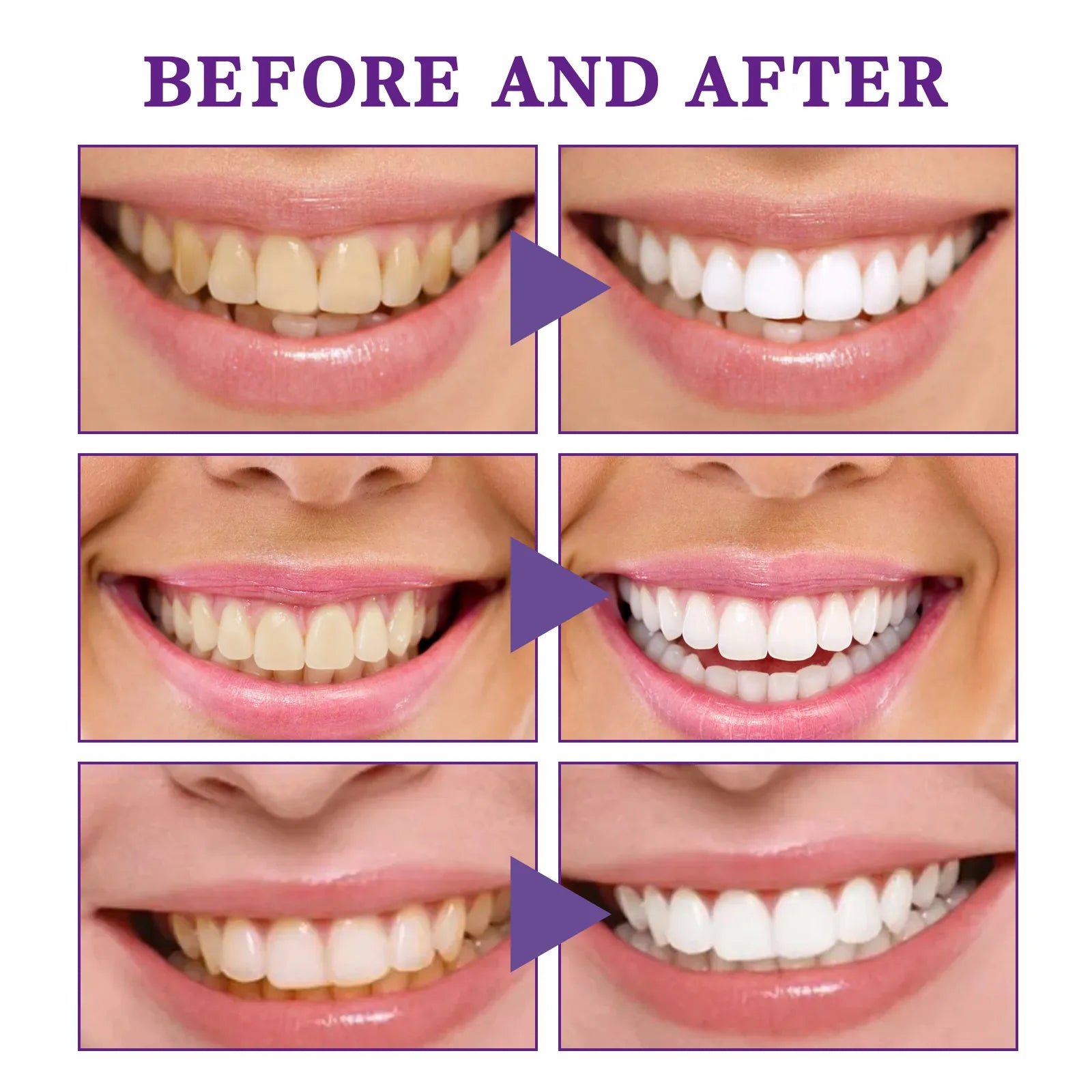 Tooth whitening before-and-after smile panels demonstrating brighter teeth