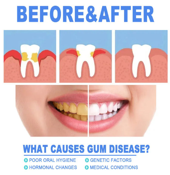 Teeth before-and-after dental chart showing gum health and teeth